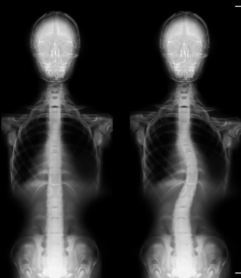 scoliosis Jacksonville NC